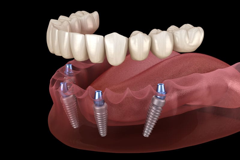 Aligners