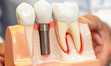 Dental Implants in Delhi