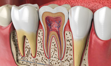 Painless RCT in Delhi